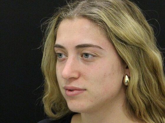 Rhinoplasty: Case 4 - After