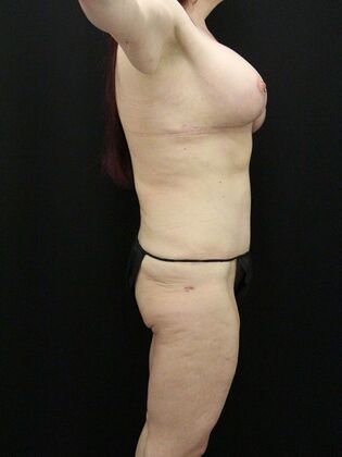 Tummy Tuck: Case 66 - After