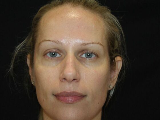 Skin Treatments Case 16 - Before
