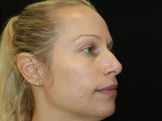 Skin Treatments: Case 16 - After