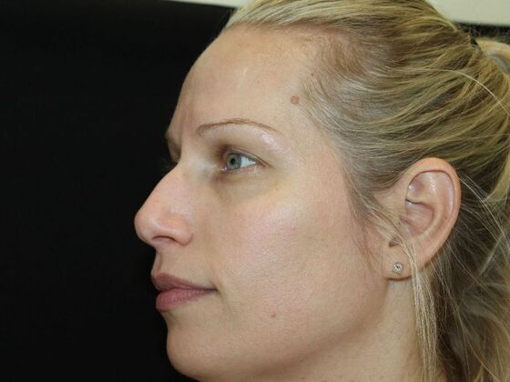 Skin Treatments: Case 16 - After