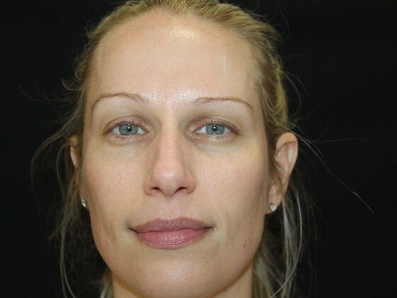 Skin Treatments Case 16 - After