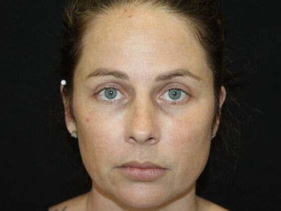 Skin Treatments Case 18 - Before