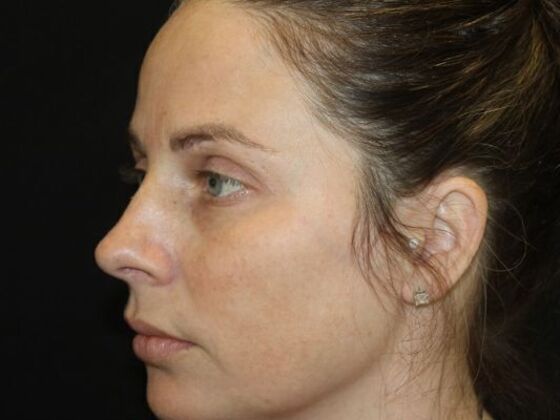 Skin Treatments: Case 18 - Before