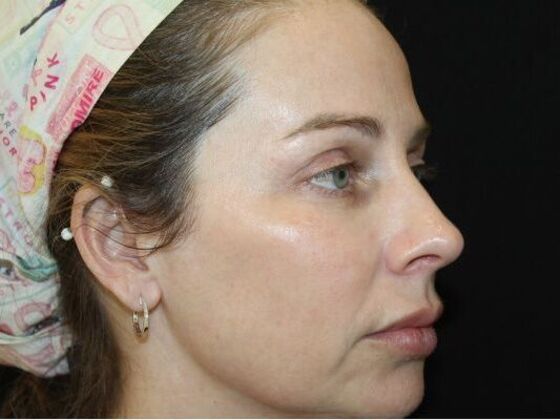Skin Treatments: Case 18 - After