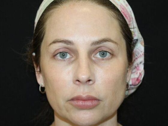Skin Treatments Case 18 - After