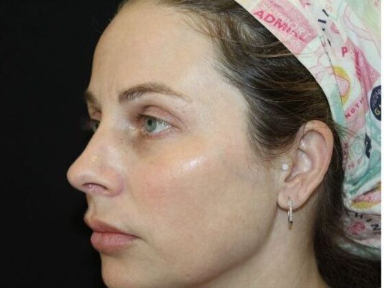 Skin Treatments: Case 18 - After