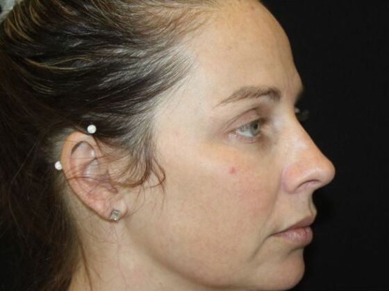 Skin Treatments: Case 18 - Before