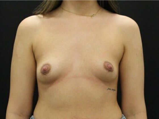 Breast Augmentation: Case 118 - Before