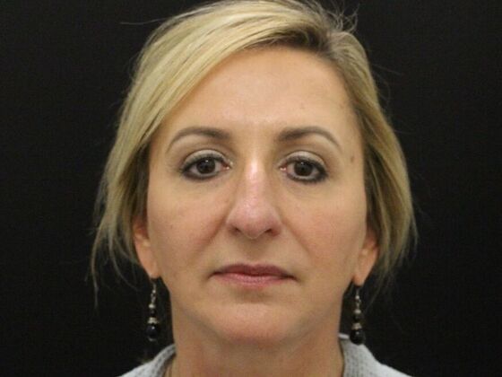 Rhinoplasty Case 4 - Before