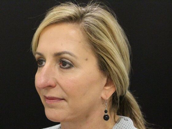 Rhinoplasty: Case 4 - Before