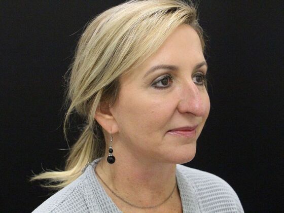 Rhinoplasty: Case 4 - Before