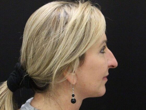 Rhinoplasty: Case 4 - Before