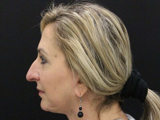 Rhinoplasty: Case 4 - Before