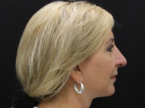 Rhinoplasty: Case 4 - After