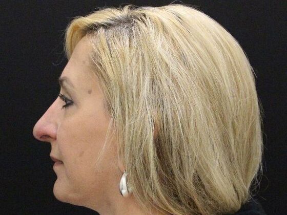 Rhinoplasty: Case 4 - After