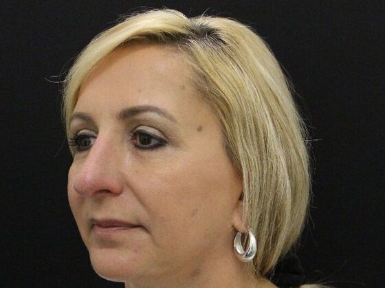 Rhinoplasty: Case 4 - After