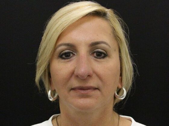 Rhinoplasty Case 4 - After