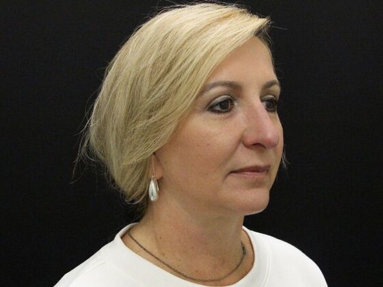 Rhinoplasty: Case 4 - After