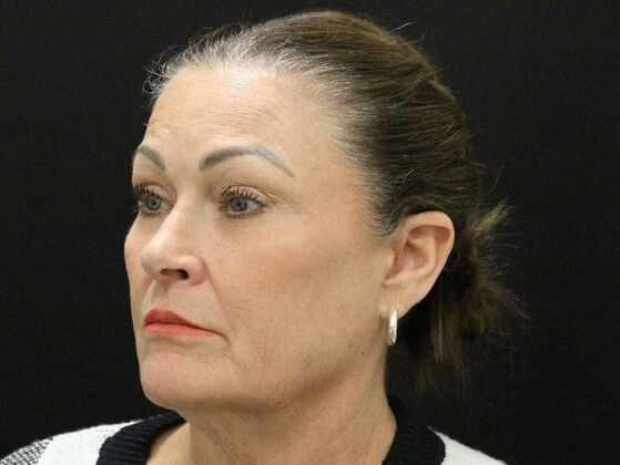 Face & Neck Lifts: Case 51 - Before