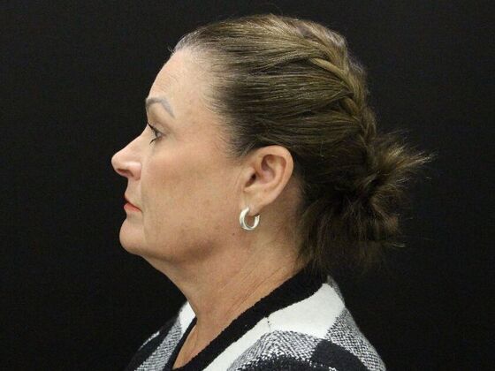 Face & Neck Lifts: Case 51 - Before