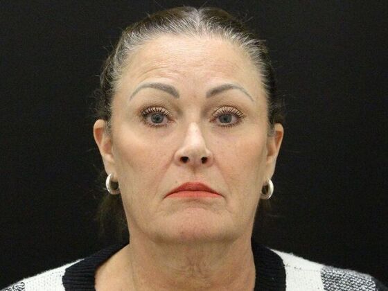 Face & Neck Lifts: Case 51 - Before