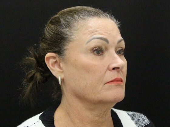 Face & Neck Lifts: Case 51 - Before