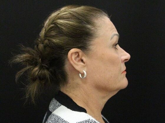 Face & Neck Lifts: Case 51 - Before