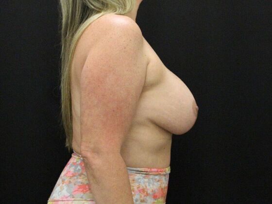 Breast Lift & Breast Lift Augmentation: Case 51 - After