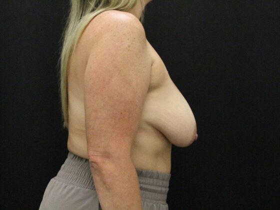 Breast Lift & Breast Lift Augmentation: Case 51 - Before