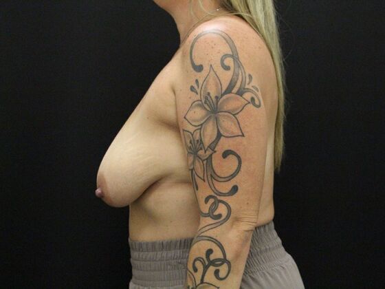 Breast Lift & Breast Lift Augmentation: Case 51 - Before