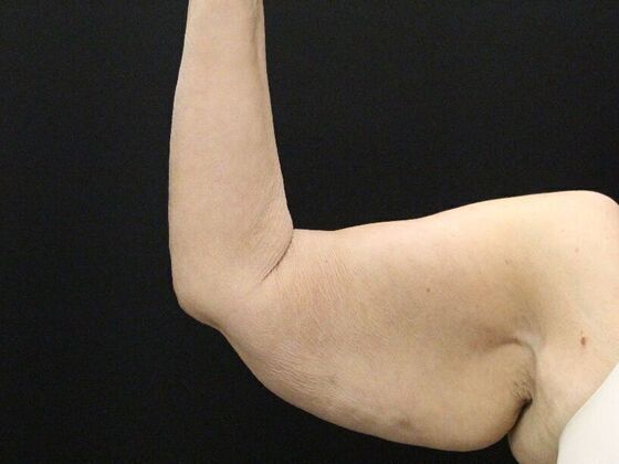 Arm Lift Case 26 - Before