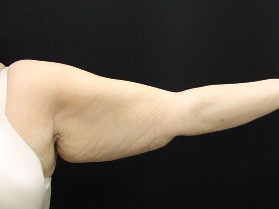 Arm Lift: Case 26 - Before