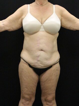 Tummy Tuck: Case 78 - Before