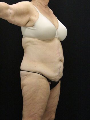 Tummy Tuck Case 78 - Before