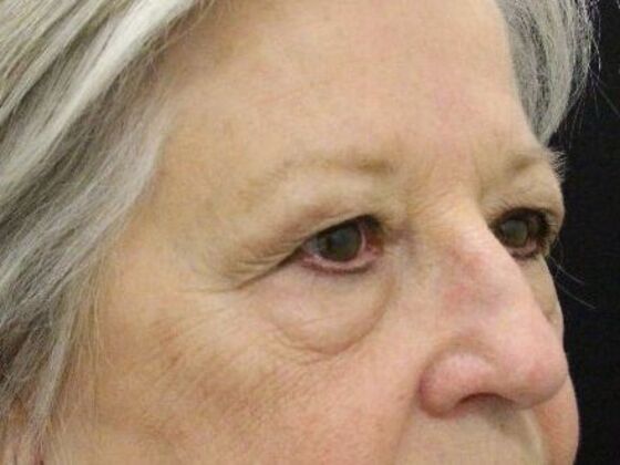 Non-Surgical: Case 13 - Before