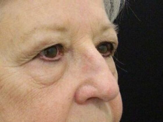 Eyelid Surgery Case 18 - Before