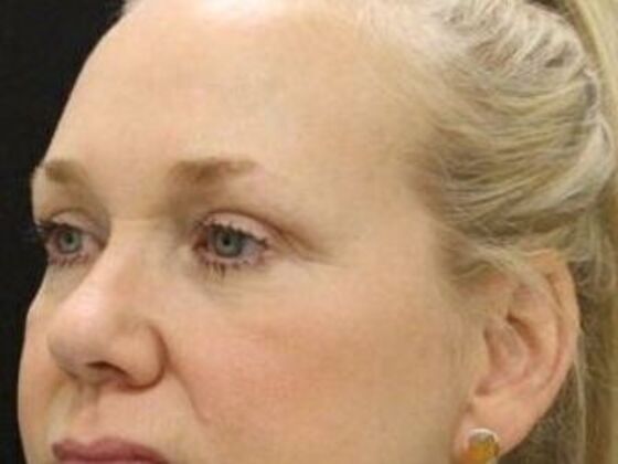 Eyelid Surgery: Case 19 - After