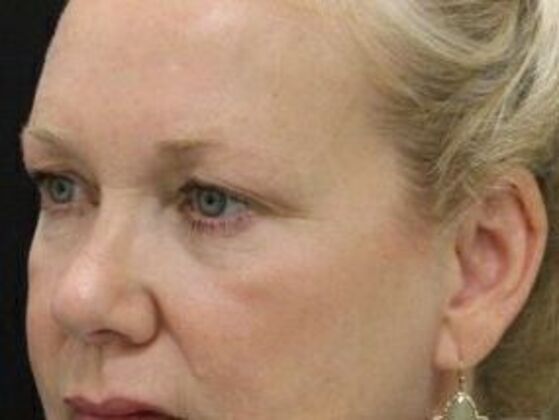 Eyelid Surgery: Case 19 - Before