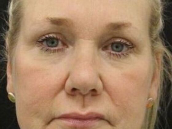 Eyelid Surgery: Case 19 - After