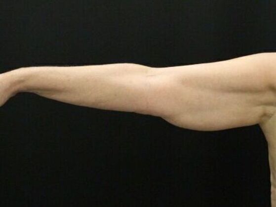 Arm Lift: Case 27 - Before