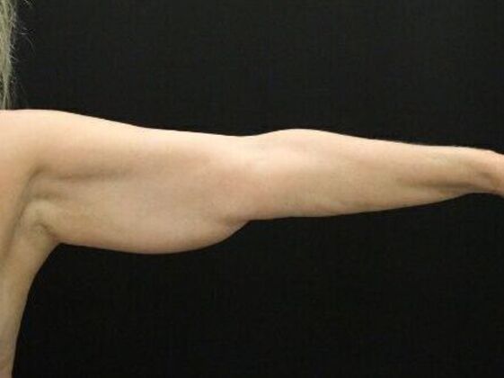 Arm Lift Case 27 - Before