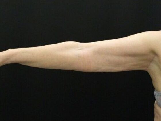 Arm Lift: Case 27 - After