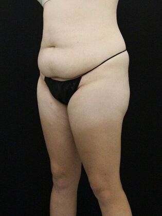 Tummy Tuck: Case 79 - Before