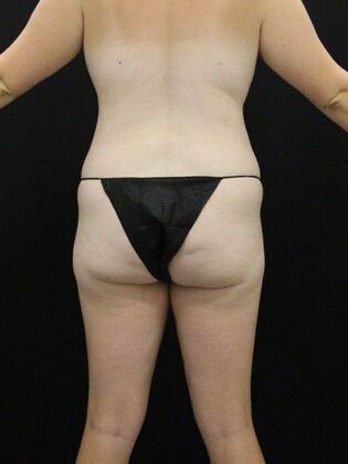 Tummy Tuck: Case 79 - Before