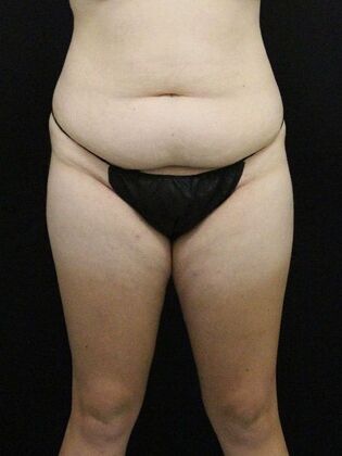 Tummy Tuck Case 79 - Before
