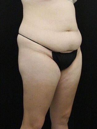 Tummy Tuck: Case 79 - Before