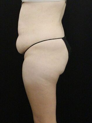 Tummy Tuck: Case 79 - Before