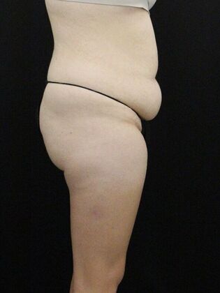 Tummy Tuck: Case 79 - Before