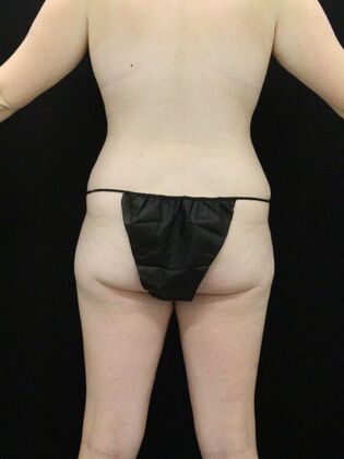 Tummy Tuck: Case 79 - After